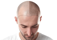 scalp-micropigmentation-hogsta-kvalitet-scalp-micropigmentation-capillos-stockholm-1 (1)